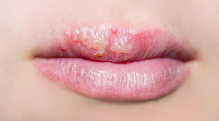 herpes on the lips how to cure forever