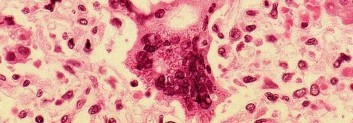 measles virus symptoms