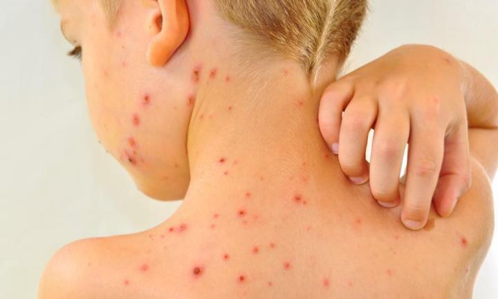 Stages of chickenpox in children
