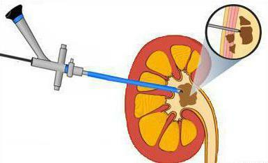 laserové odstránenie kameňov v močovej trubici