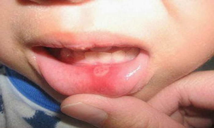 in the mouth of a pimple