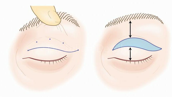 blepharoplasty of the upper eyelid rehabilitation