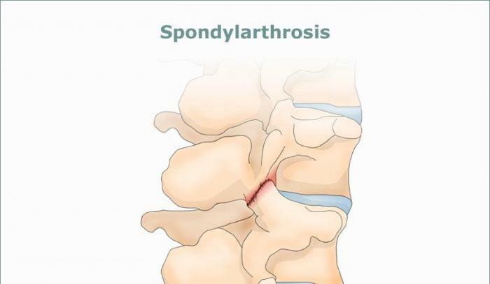 spondylartrózy bedrovej chrbtice