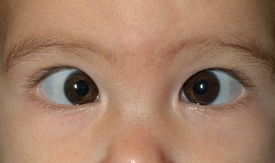 strabismus in children under one year old