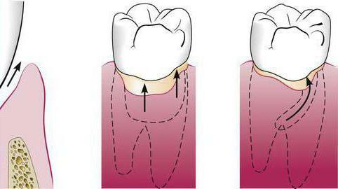 periodontal pocket