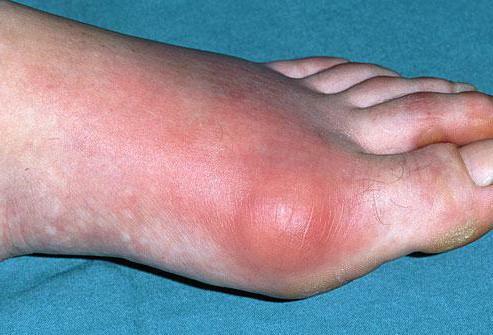 Disease of the toes