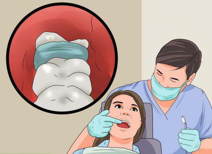 alveolitis after tooth extraction at home