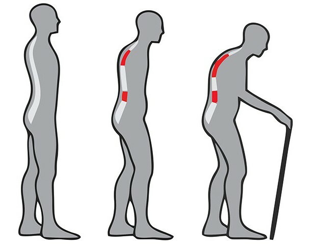 ankylosing spondylitis prediction for life