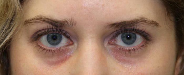 fillers under the eyes