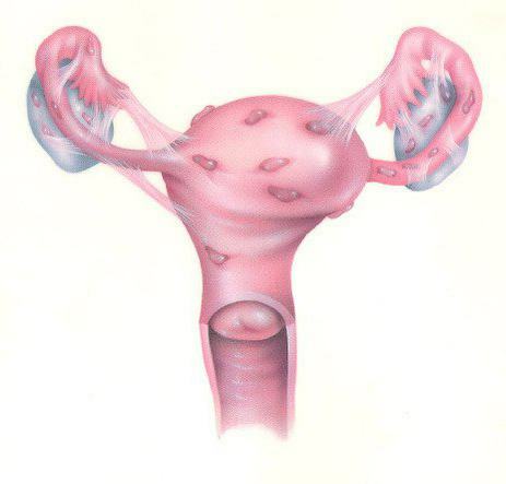 endometrioid cyst of the right ovary
