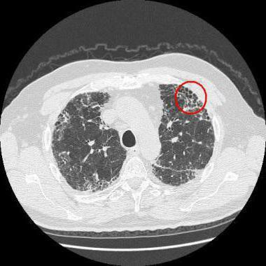 idiopathic hemosiderosis of the lungs in children