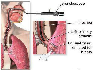 bronkoskopi av lungorna är vad det är recensioner