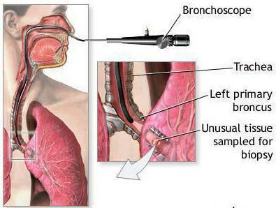 bronchoskopia pľúc je to, čo je to hodnotenie