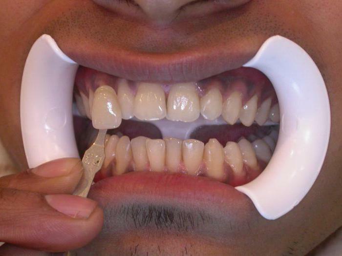 effective methods of teeth whitening