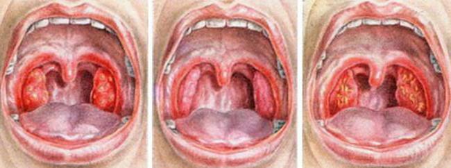 photos of strep throat