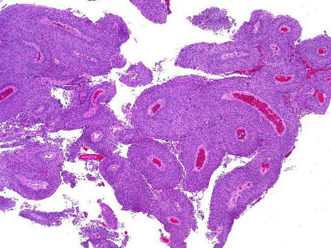 carcinomul celular scuamos al colului uterin