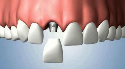 temporary crowns for implants