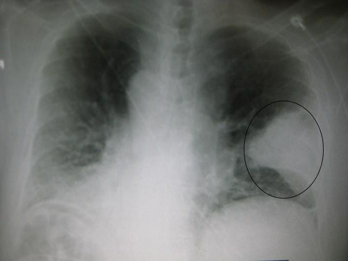 hipostatic pneumonie