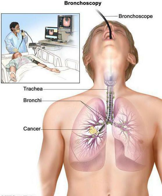 bronkoskopi i lungorna vad det är