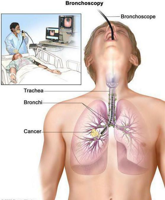 bronchoskopia pľúc, čo to je