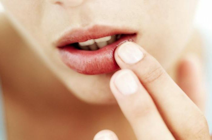 Causes and Treatment of Herpes on the Lips