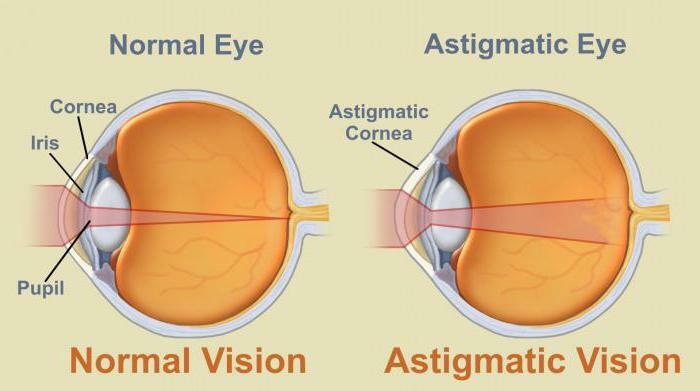 astigmatism in children