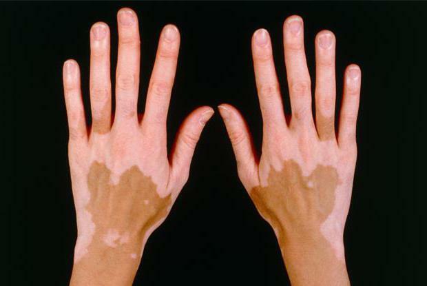 krémový vitasan od vitiligo odzывы