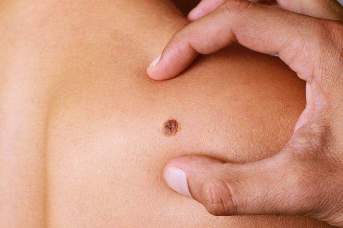 removal of cancer moles