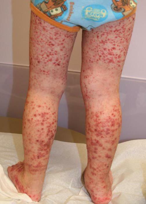 allergic vasculitis in children