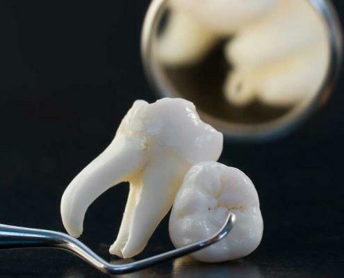 it is painful to remove the roots of the destroyed tooth