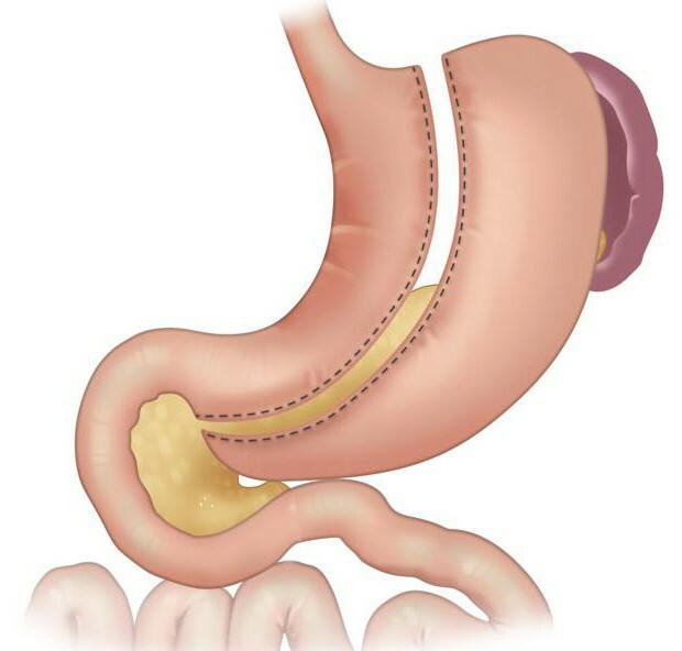 volume of the stomach