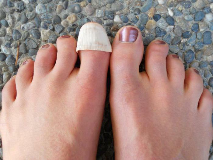 exfoliation of the nail on the big toe of the cause