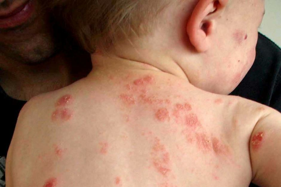 manifestations of an allergy in a young child