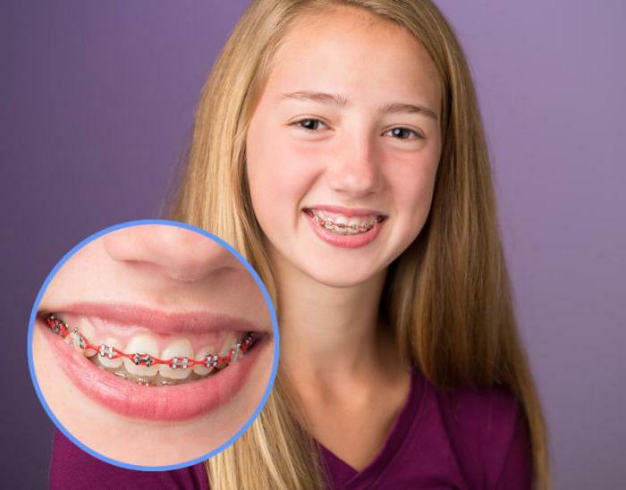 is it painful to put braces