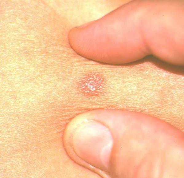 laser treatment of basal cell carcinoma