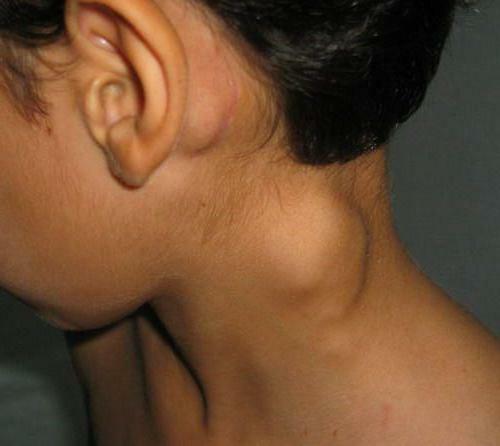 cisto cervical