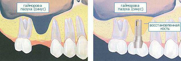 What is a sine lifting with a tooth implant?