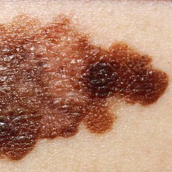 melanoma skin projections of life in russia