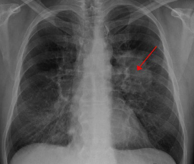 carcinoma of lung treatment