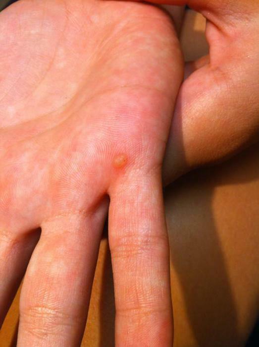 why there are warts on the fingers