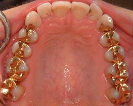 prosthetics of teeth in gold