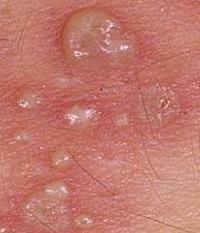 Was sind Herpes-Pillen auf den Lippen?