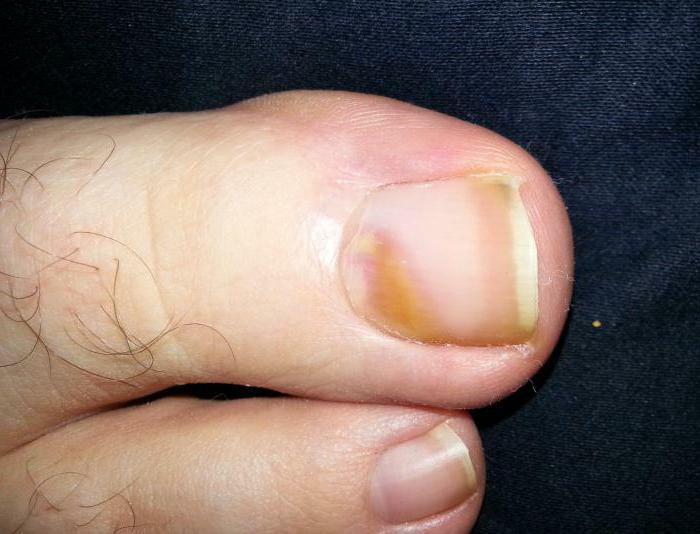 Foot Nail Melanoma