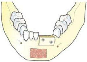 Bone plastic surgery for implantation of teeth