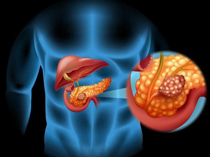 Etiologia pancreatitei acute