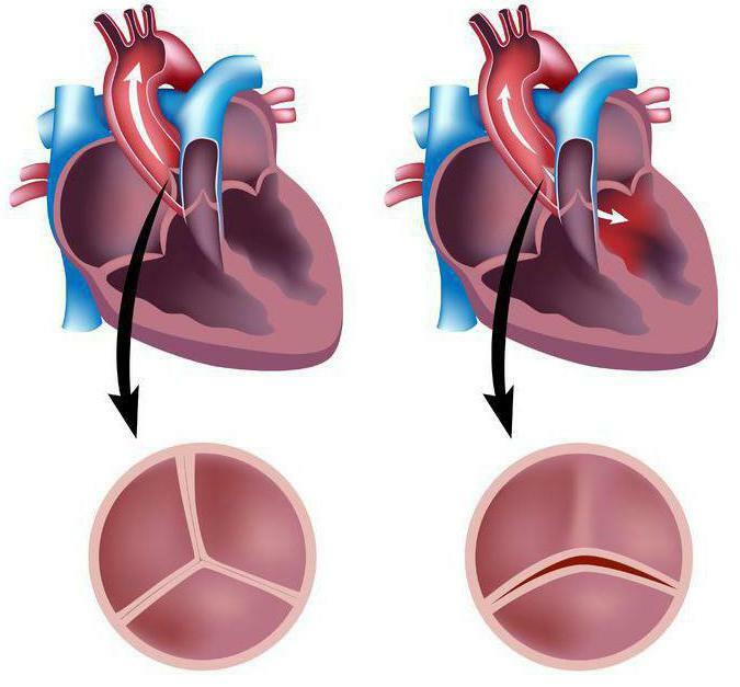 aortic bicuspid valve