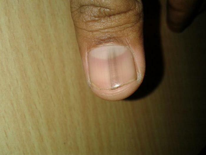 Melanoma of the nail: photo