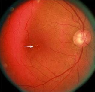macular retinal rupture