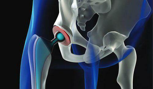 rehabilitation after surgery fracture of the neck of the hip transition to the cane