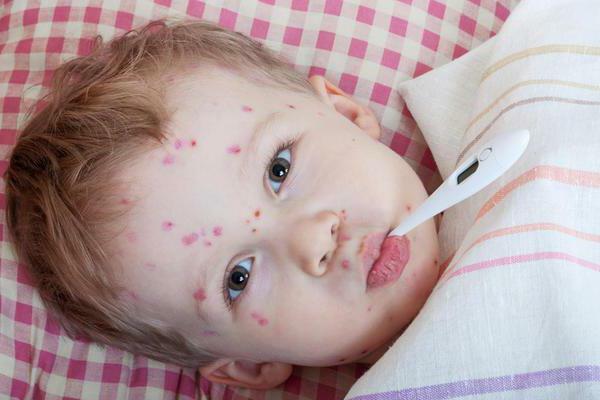 Types of complications after chickenpox